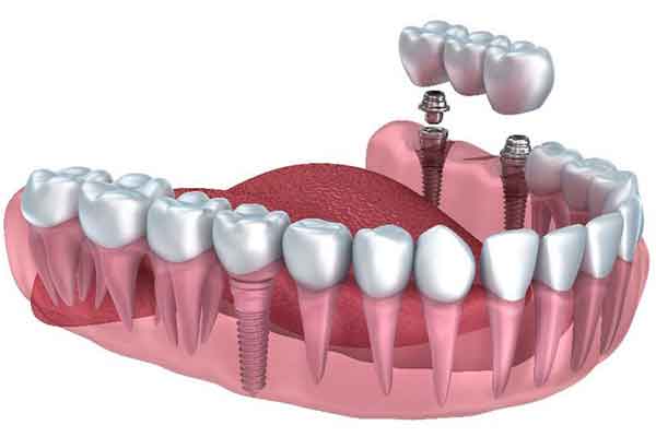 Prosthodontics